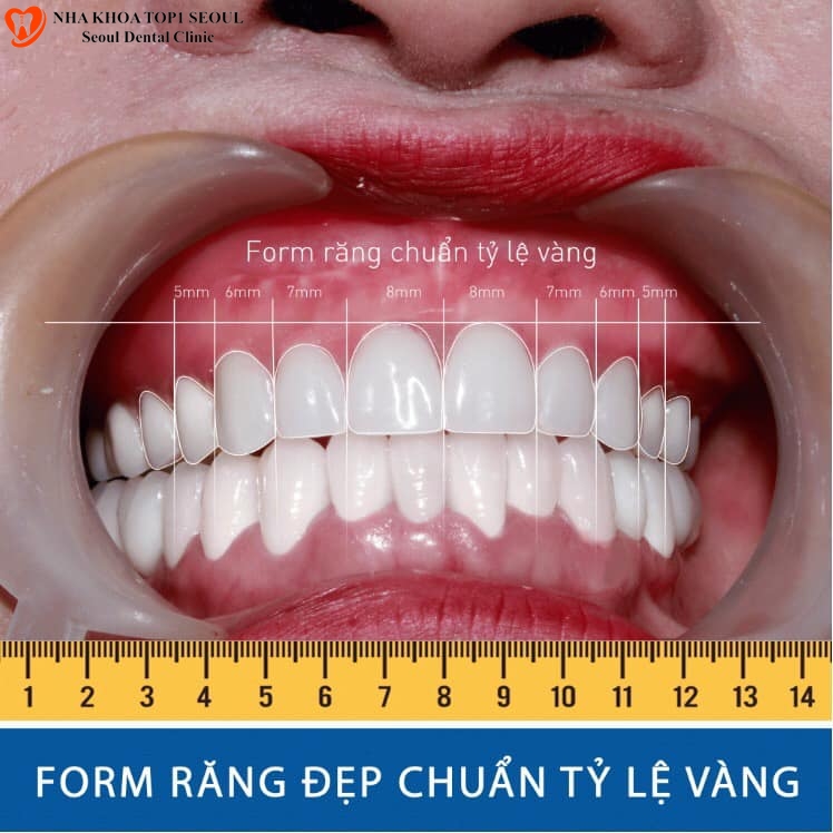 1. Khái Niệm Về Hàm Răng Chuẩn