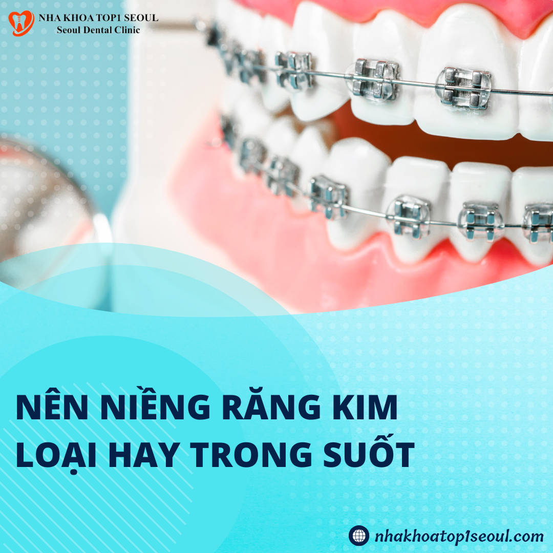 nên niềng răng mắc cài hay trong suốt