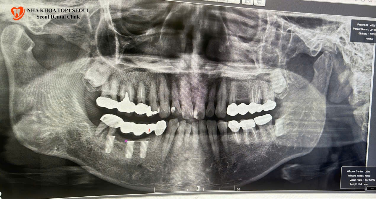 cấy ghép implant