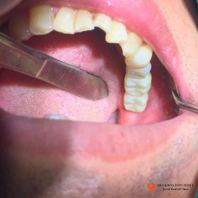 cấy ghép implant