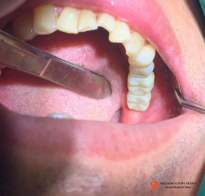 cấy ghép implant