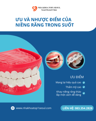 ưu điểm của niêng răng trong suốt