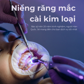 niềng răng mắc cài kim loại là gì
