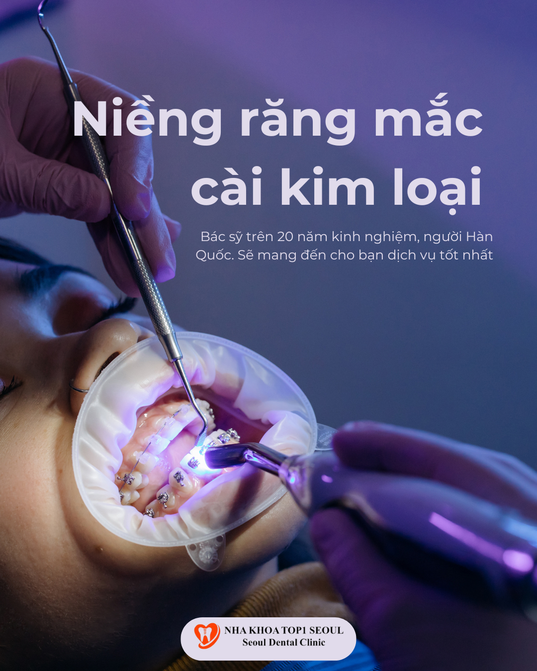 niềng răng mắc cài kim loại là gì