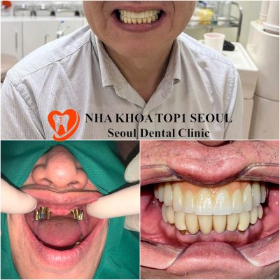 ưu điểm của trồng răng implant